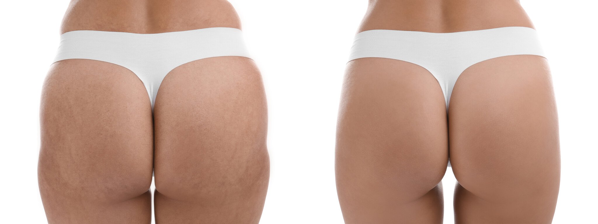 Best Cosmetic Procedures for Removing Cellulite2